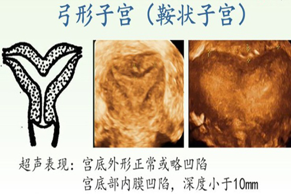 女性如果是弓形子宫能正常生育吗，听听生殖专家怎么说
