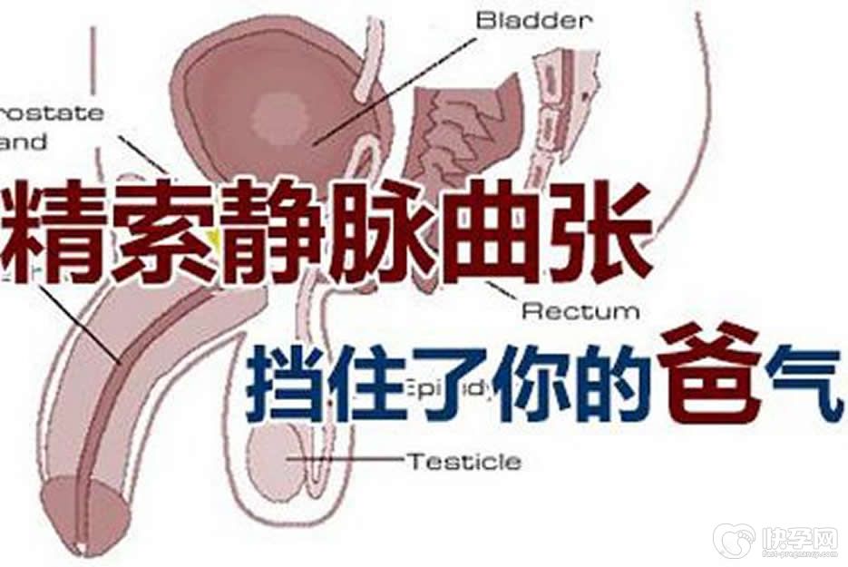 精索静脉曲张可能会引起男性不孕不育，所以这三类人需要注意！！