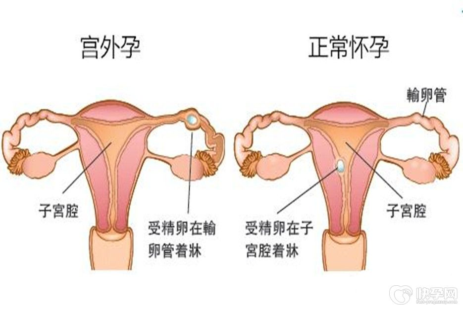 宫外孕会导致不孕不育吗？不为人知的医学识知