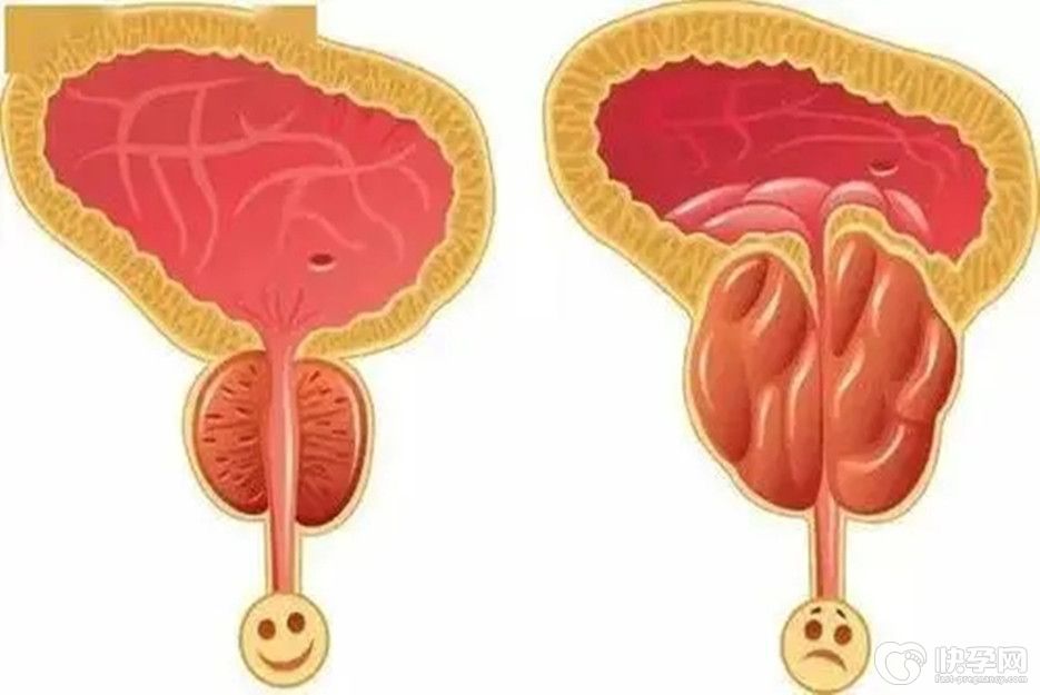 前列腺结石会导致不孕不育吗？防范大于未然，病到极致是不育