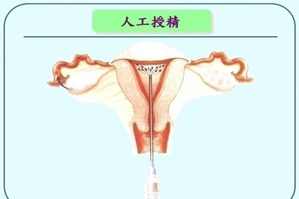 人工授精后腹痛是成功了吗？关于人工受精成功的6个症状要了解