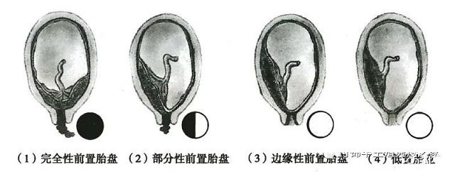 了解胎盘低置，特别担心胎盘低置对胎儿有无影响