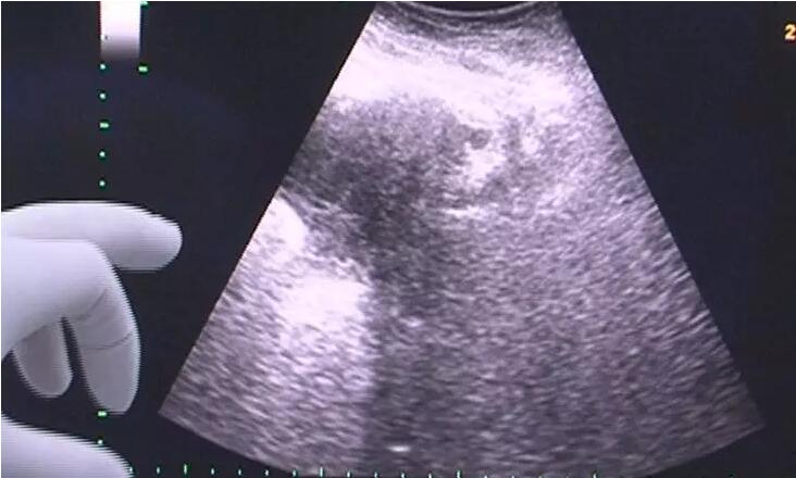 助孕做试管婴儿期间为什么要频繁的做B超检查