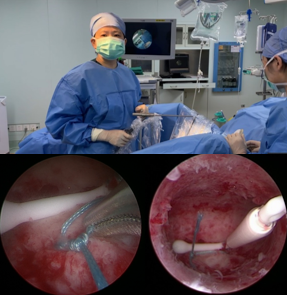 “固定环”和“组合环”带来“稳稳的”幸福——子宫腺肌病患者的福音