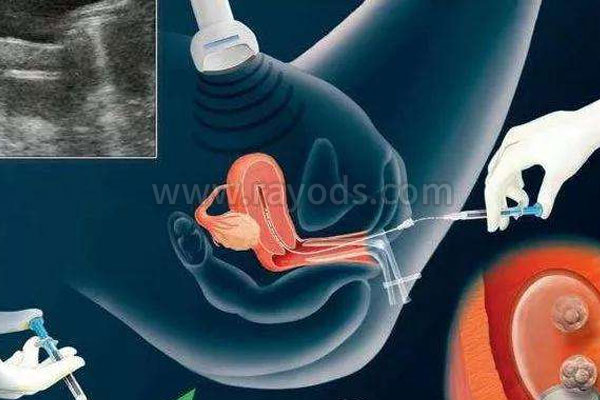 试管婴儿的过程中女方需要进行取卵相关知识点