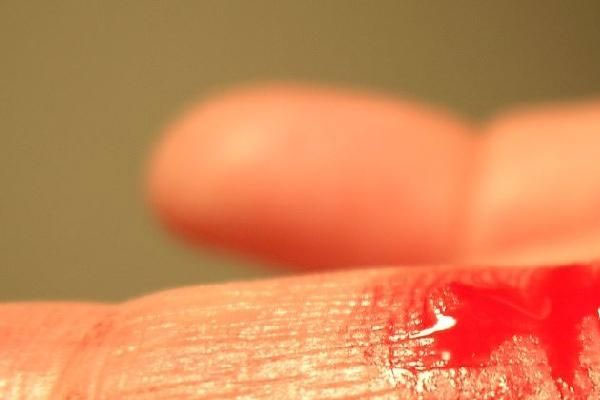 通过第三代试管婴儿成功有了不含血友病基因的宝宝