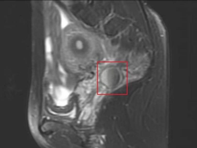 女性排便疼痛要警惕，可能盆腔长了“巧克力”？！