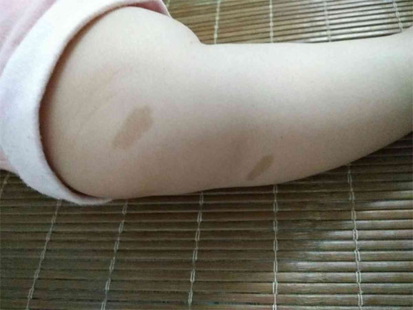 听说胎记长对位置就有福气，网传最有福气的9处胎记到底长在哪里？