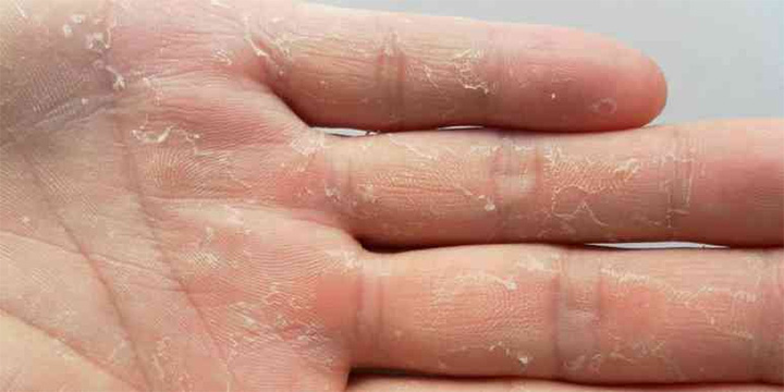 儿童手掌突然出现脱皮现象，你知道是什么原因引起的吗？