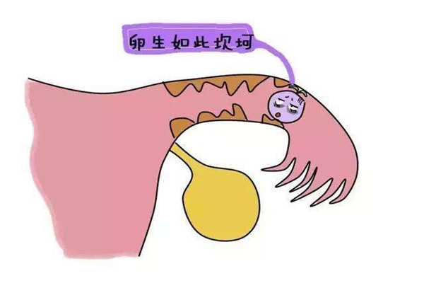 输卵管不通怎么办三种方法助你好孕