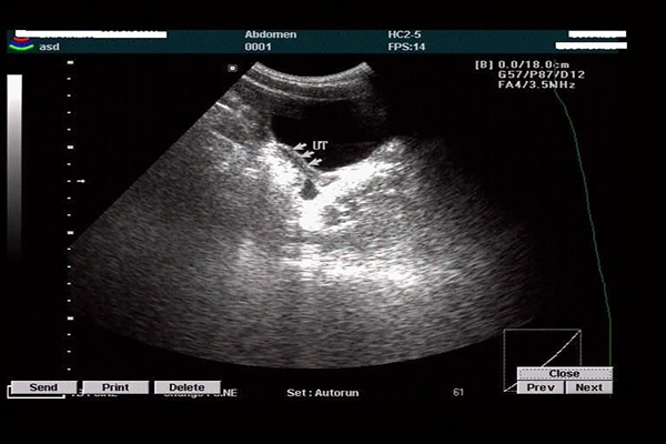 一篇文章让你清楚幼稚子宫是怎么回事