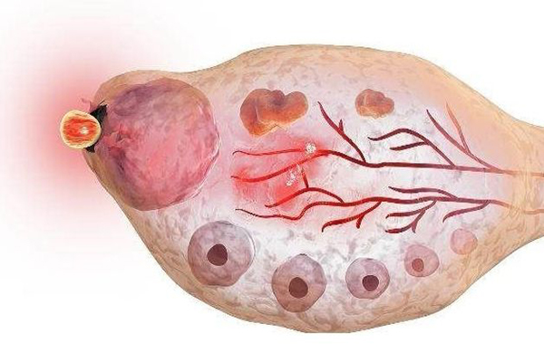 【医生笔记】盘点造成排卵障碍的6个常见原因，明确原因才能针对治疗