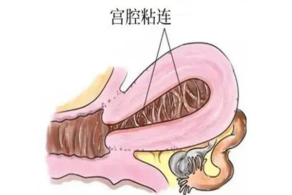 怎样确定子宫有没有粘连  月经异常是第一个征兆