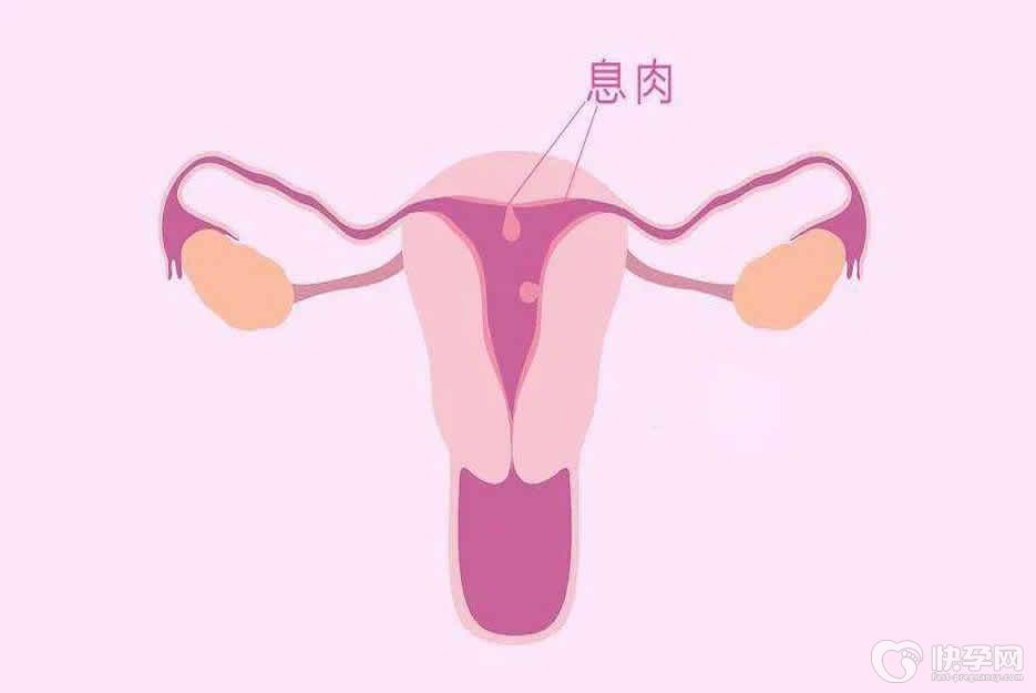 子宫内膜小息肉会影响移植吗？会！专家解读内膜息肉影响移植的原因