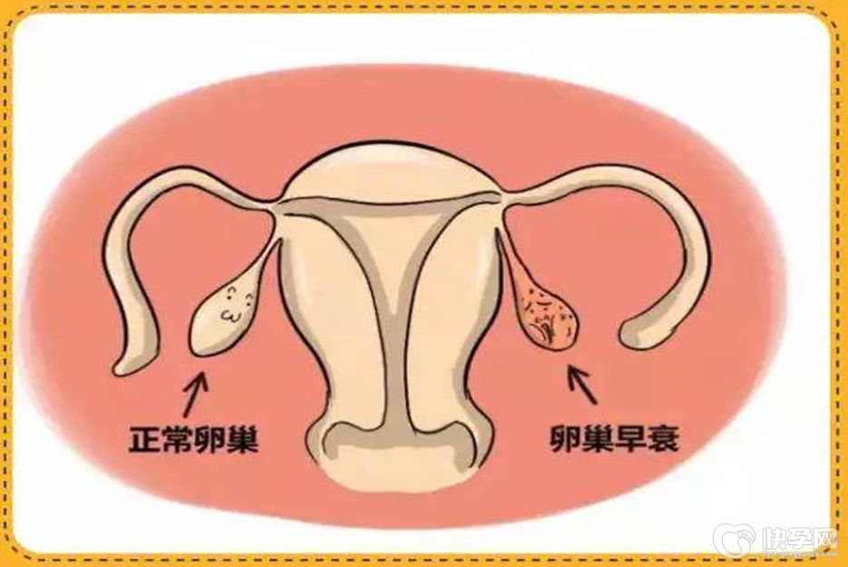 fsh高不一定卵巢早衰，原来是这么回事！