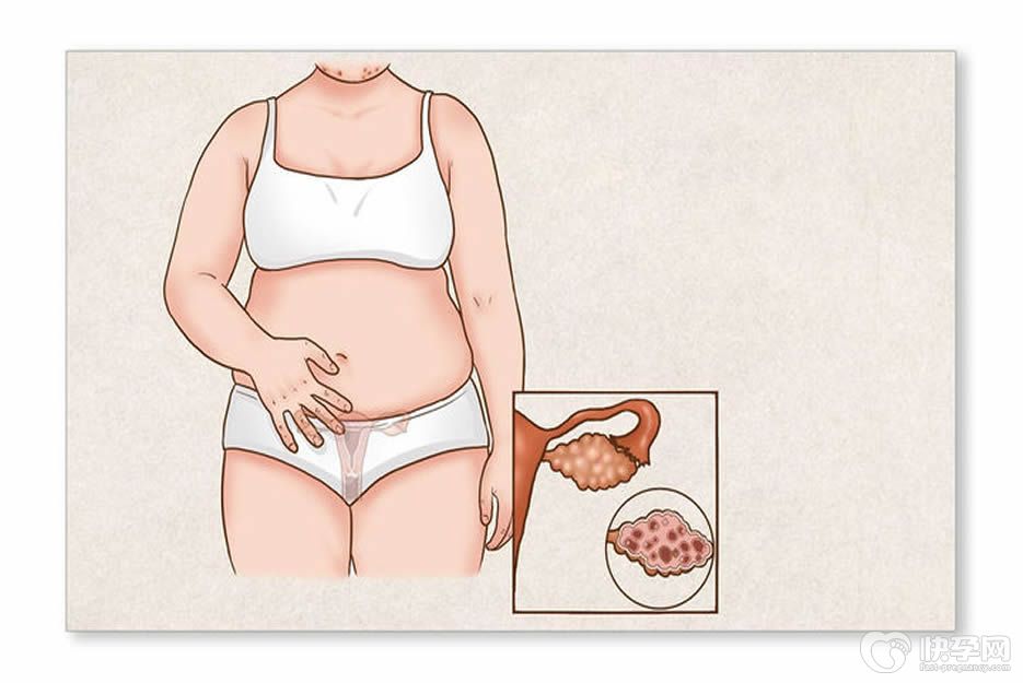 糖尿病病史多囊卵巢可以选择做试管婴儿吗？根据血糖严重情况而定