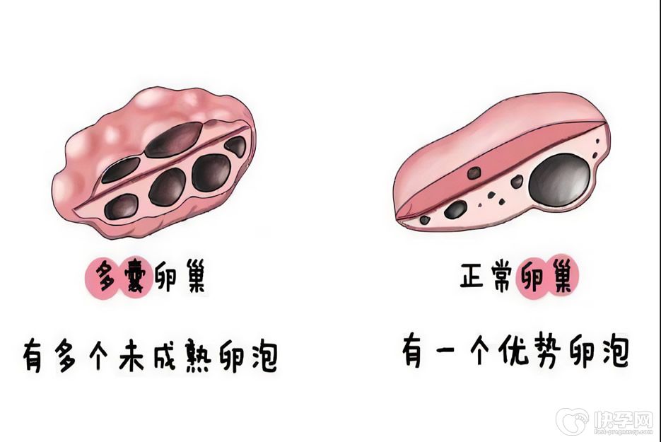 多囊卵巢患者做试管婴儿打促排卵针需要多久，一般在这个时间段