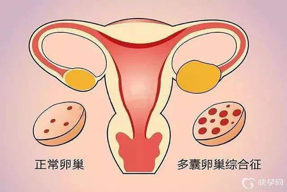 多囊一胎试管还能自然怀孕生二胎吗？排卵期千万要把握好