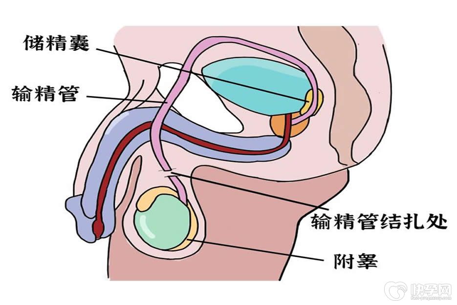 男性结扎后生育是复通术or试管婴儿？复通术vs试管婴儿