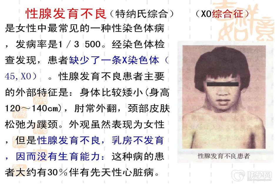 特纳氏综合征患者可以做试管婴儿吗？供卵试管技术是唯一的选择