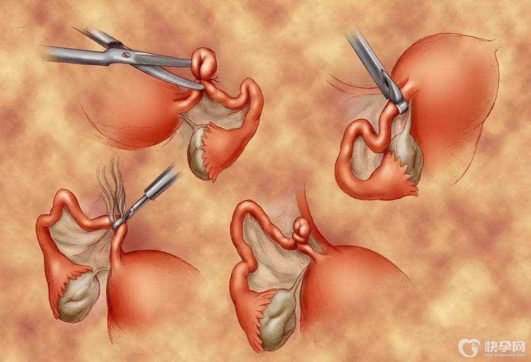 女性结扎了还可以做试管婴儿吗-只要你想要，好孕会来到