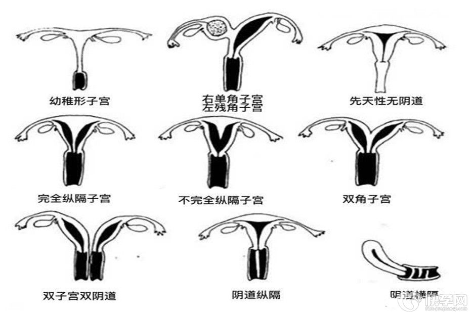 幼稚型子宫是否能怀孕？希望是有，关键在病状程度