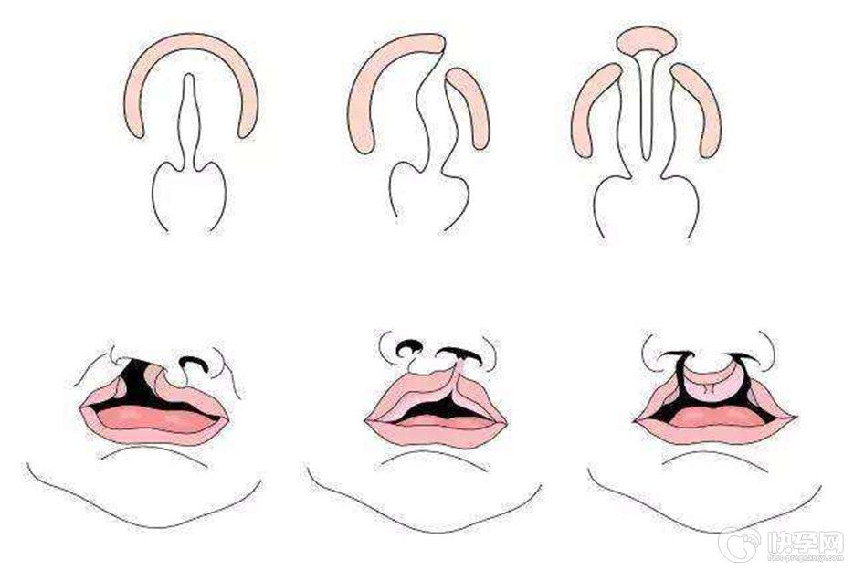 有兔唇可以做试管婴儿吗？一文解惑