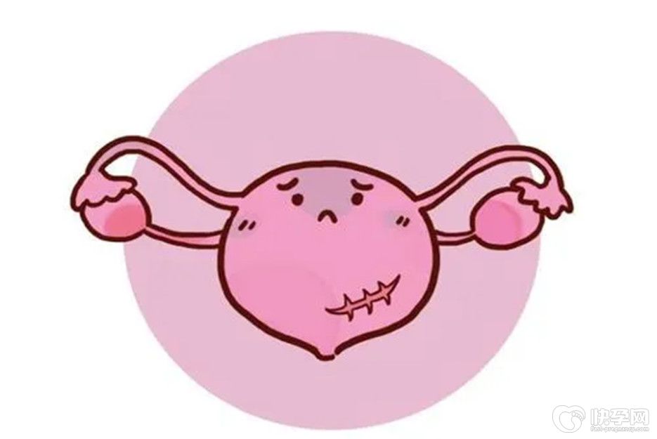 子宫疤痕憩室可以做试管吗？看完你就明白了