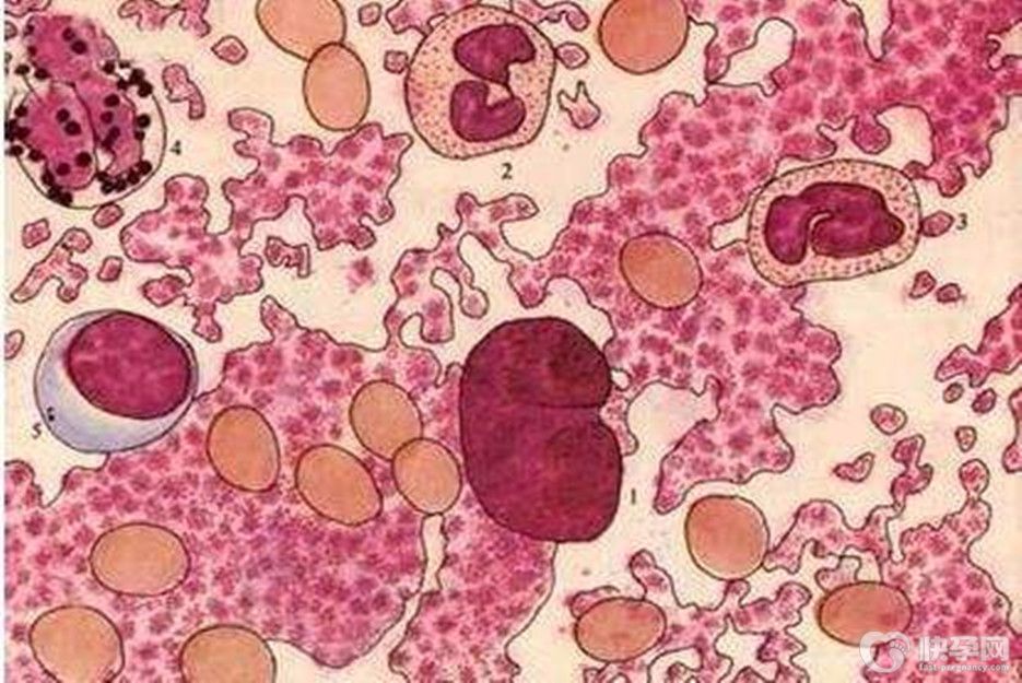 再生障碍性贫血是白血病吗，再生障碍性贫血能治好吗-虚惊一场？