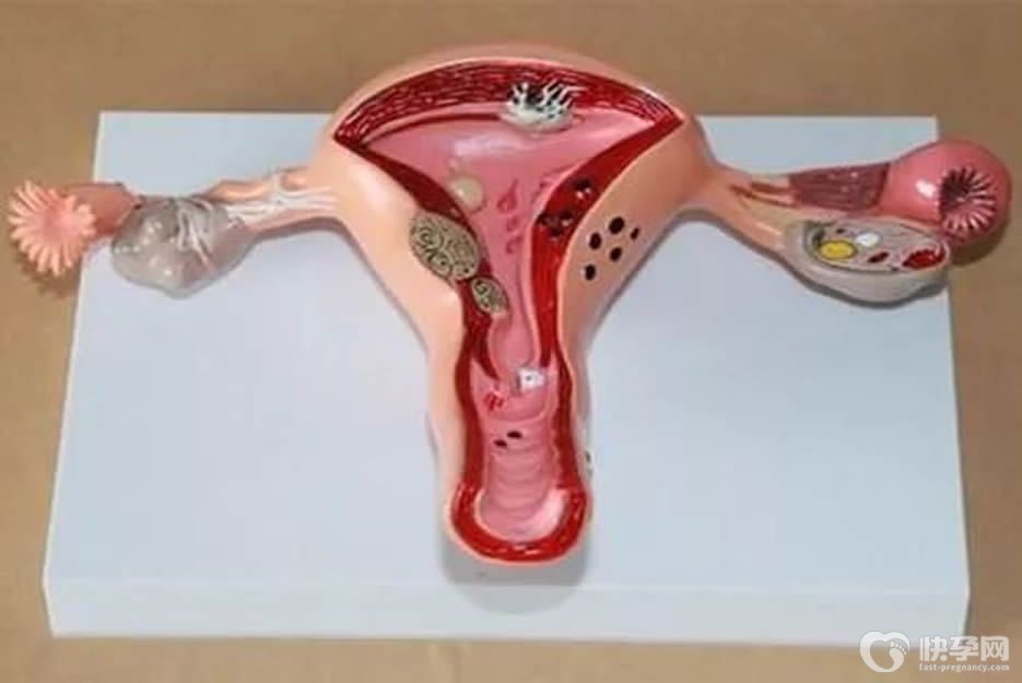 子宫内膜结核钙化想做试管有可能成功吗？建议先进行治疗