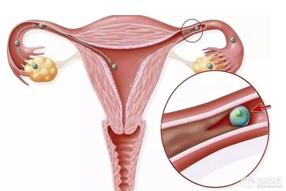 宫腔粘连的症状有哪些？宫腔粘连早期的4大症状，及早发现更利于恢复健康