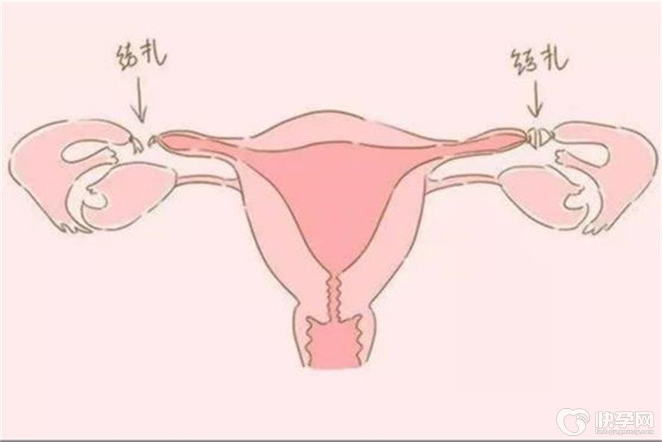 做完结扎还能做试管婴儿吗？符合条件试管生儿不是梦