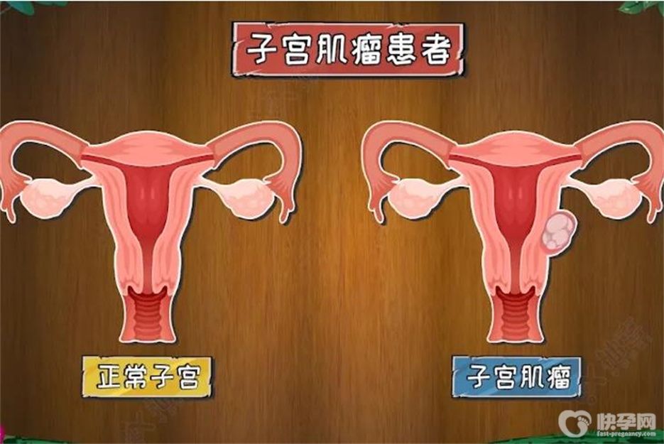 子宫肌瘤是什么原因导致的？发现子宫肌瘤后的3种有效治疗方法一定要看