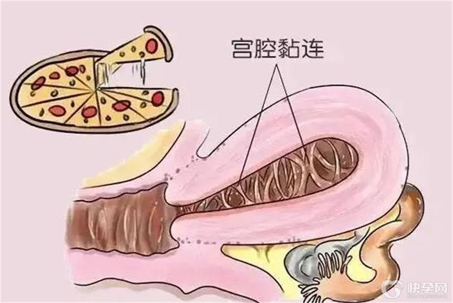 导致宫腔粘连的7大病因，作为女性我们都应该时刻警惕