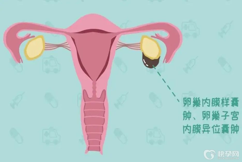 子宫内膜异位症可以自然怀孕吗？医生一般不告诉你