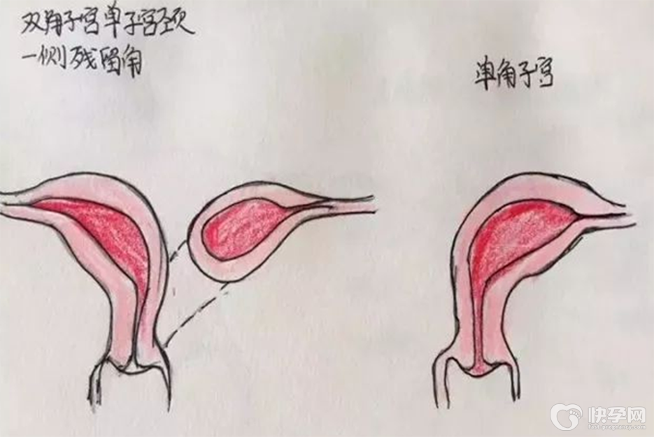 特别关注：5分钟告诉你单角子宫和双角子宫的区别-附图解