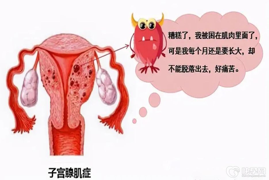 专题发布：子宫腺肌症怀孕有风险吗？坚持怀孕危害竟然这么大