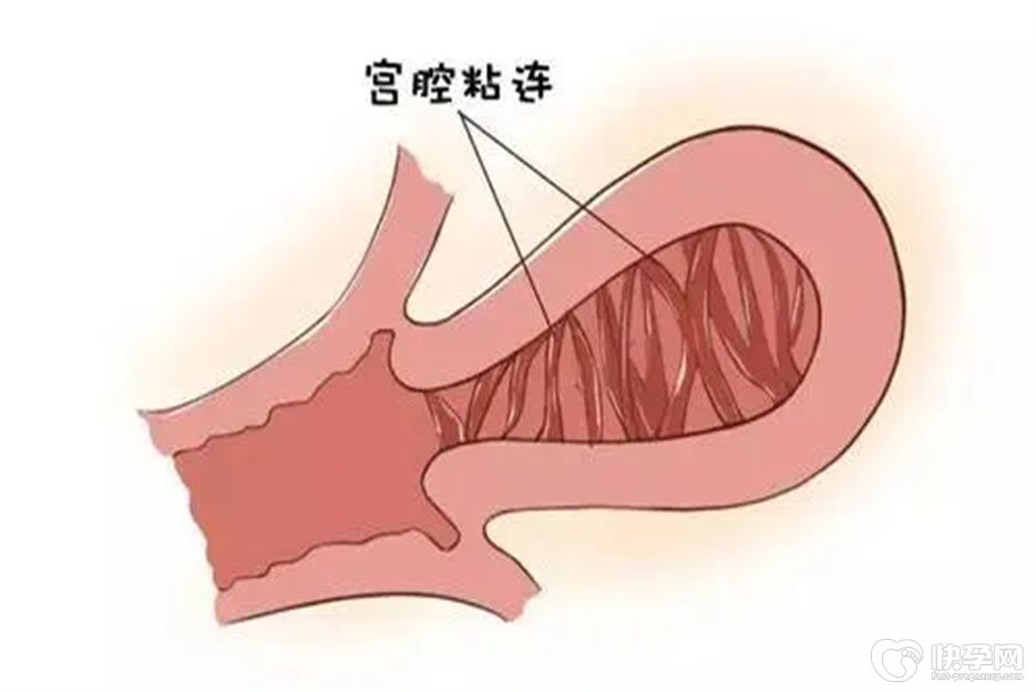 宫腔粘连0.3cm严重吗？会影响怀孕吗？一文给你解释的明明白白