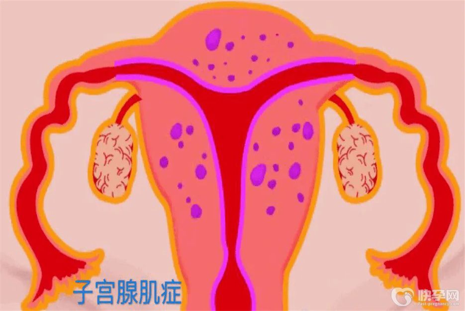 子宫腺肌症备孕需要注意什么？这四点是重中之重