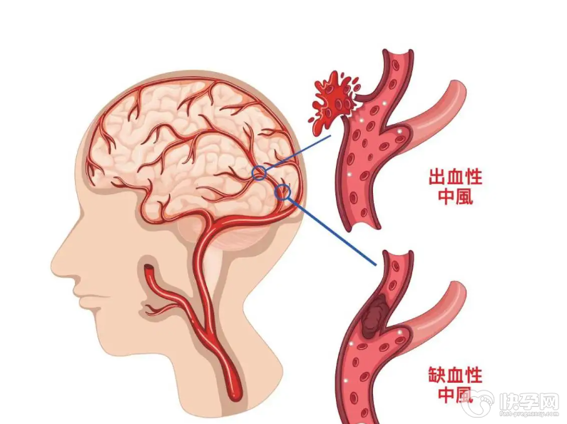 脑中风的6个前兆，出现这些现象就要做好预防