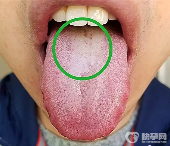 舌苔黄厚腻是什么原因造成的？大多是这五个因素在作怪