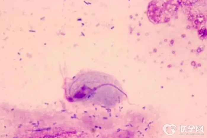 怎么判断霉菌还是滴虫性阴道炎，看完这篇文章就清楚了