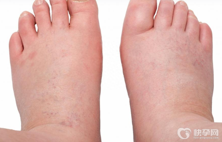 怎样快速消除身体水肿，8个小窍门快速去水肿