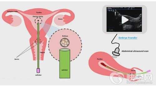 子宫偏小试管生育可以做双胞胎吗？内附双胎风险和费用详情