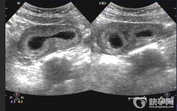 试管婴儿选择性别的流程是什么?生男生女早知道！