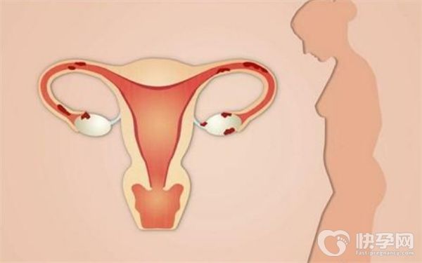 双侧输卵管堵塞医生直接让做试管婴儿吗？