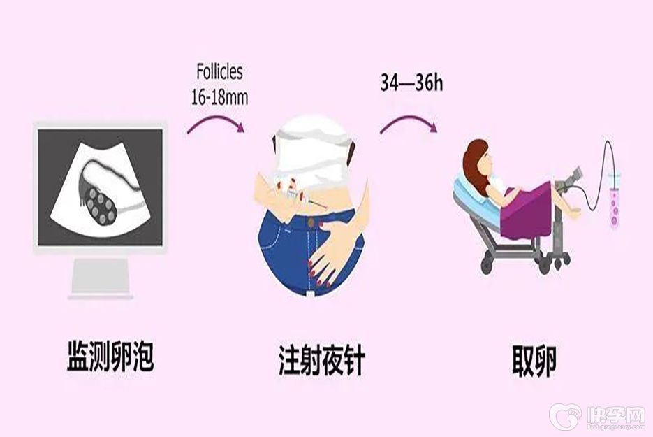 试管婴儿促排卵方案最全科普讲解，看看哪种方案更适合你！