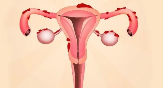 子宫全切后还能做试管婴儿吗？没子宫能不能生育？