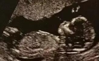 已生女孩的nt值是多少？男孩女孩nt值有什么区别？