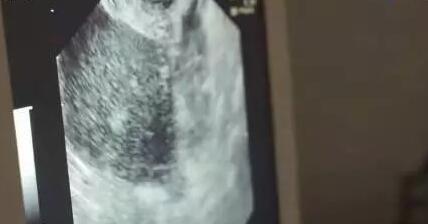 借卵代怀生子需要多少费用？附费用明细？